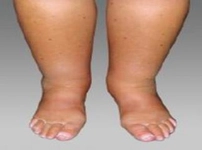 Ayak Bileği Kemik Ödemi Belirtileri ve Tedavisi