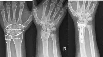 Bilek Kırığı Belirtileri ve Tedavisi