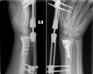 Kırık Bilek Belirtileri ve Tedavisi